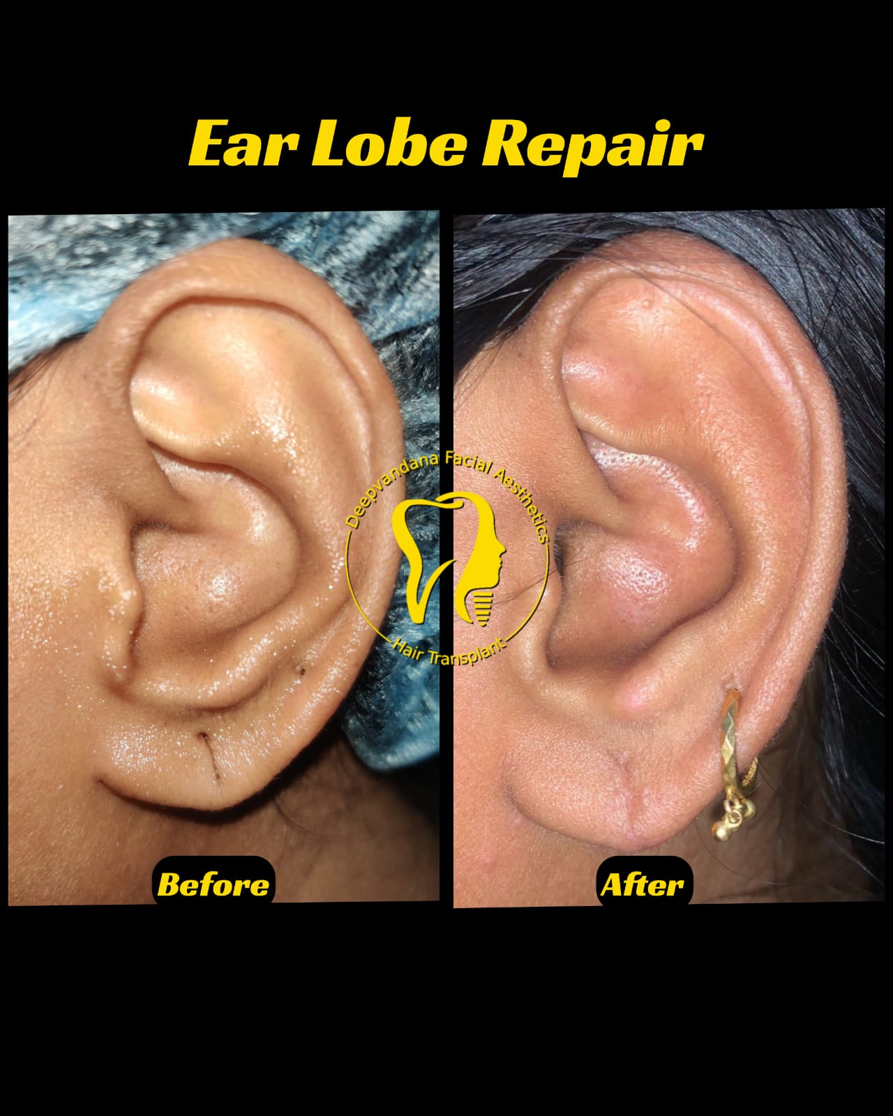 Earlobe repair close view