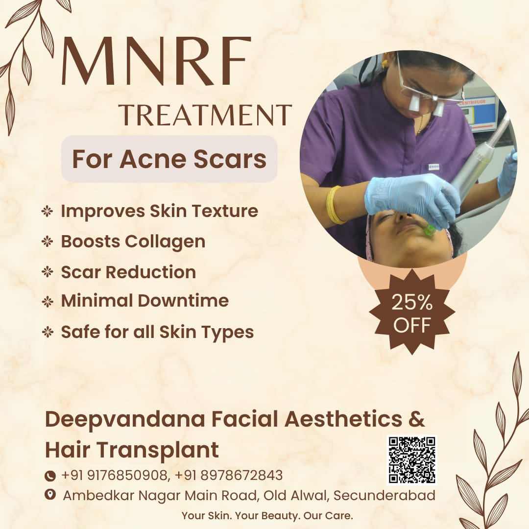 MNRF treatment for acne scars