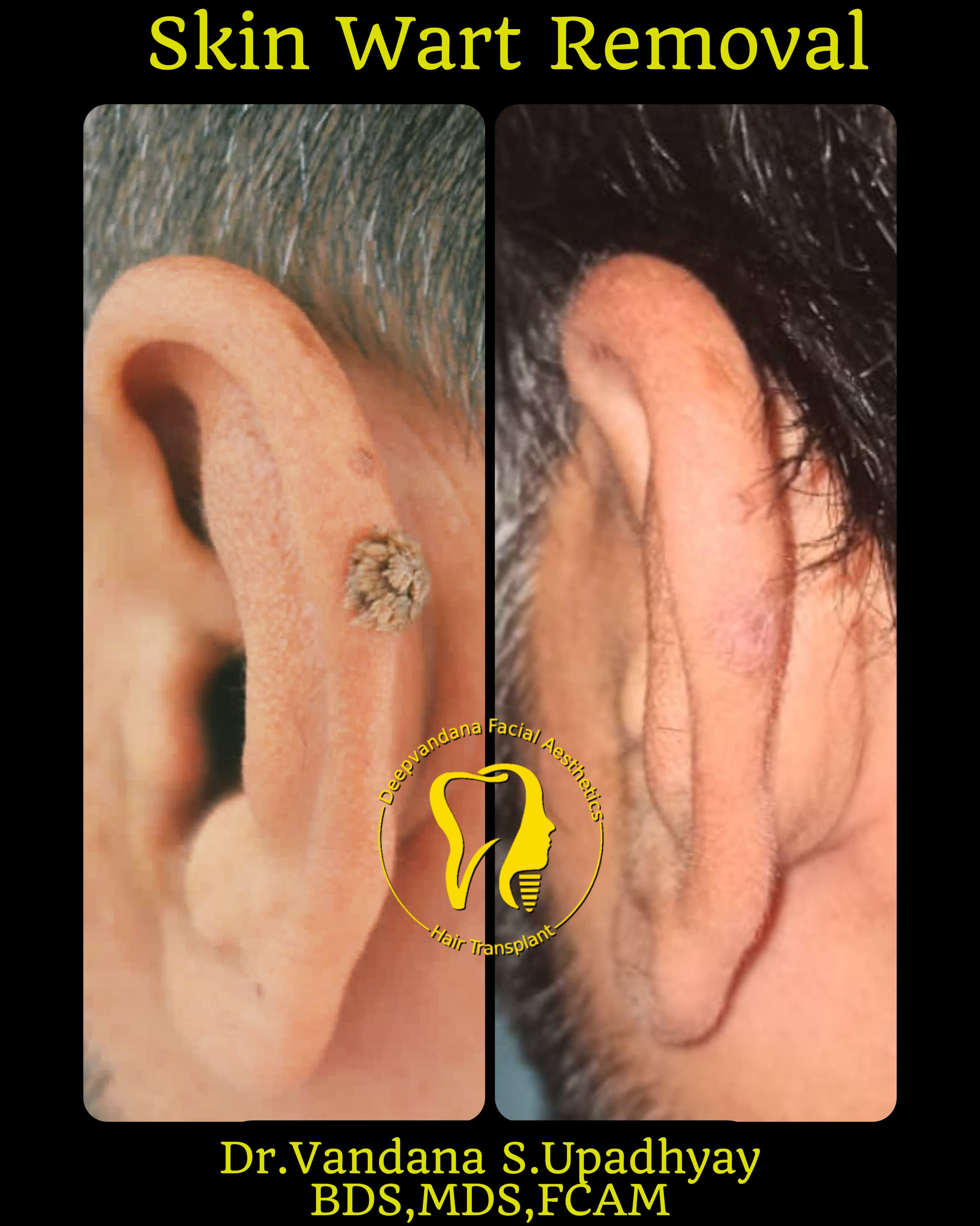 Skin wart removal case