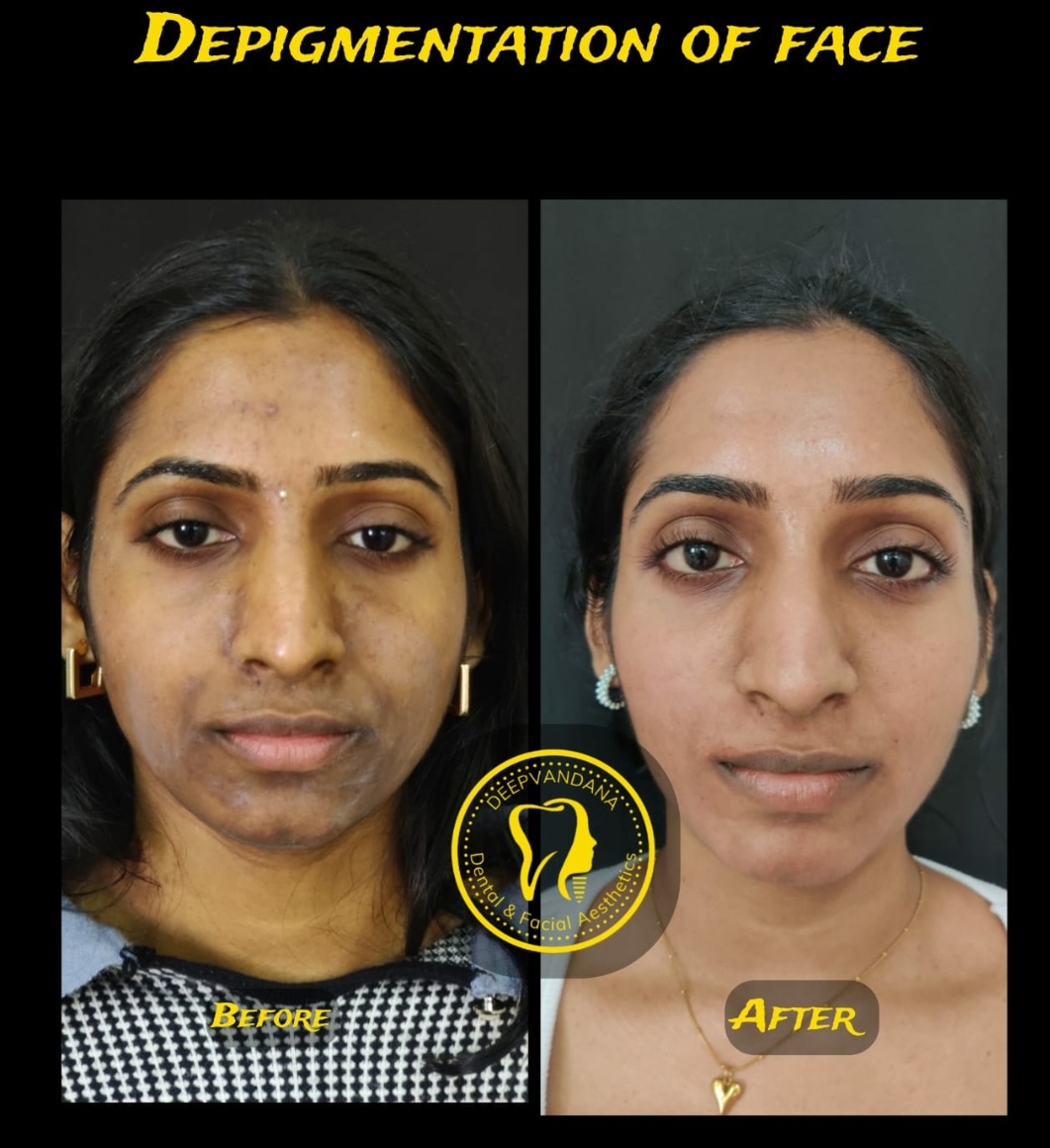 Depigmentation of face