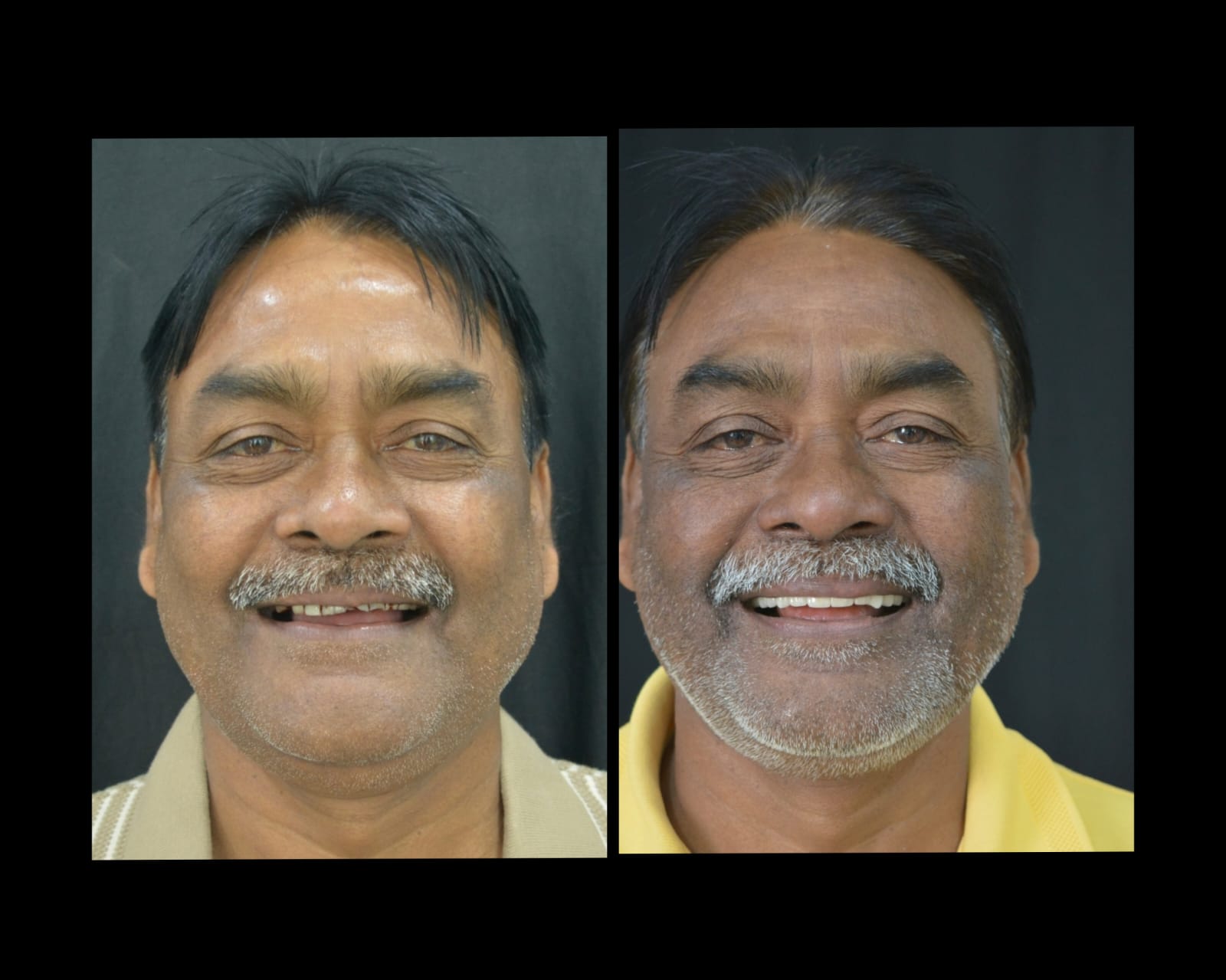 Full-mouth crowns case 3