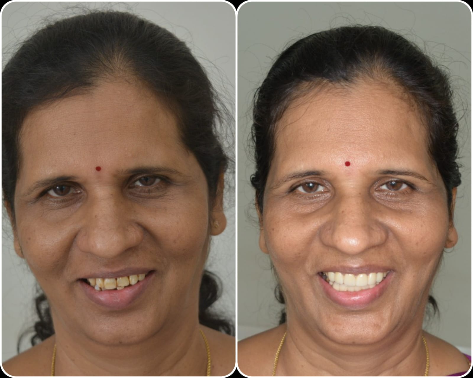 Full-mouth crowns case 5