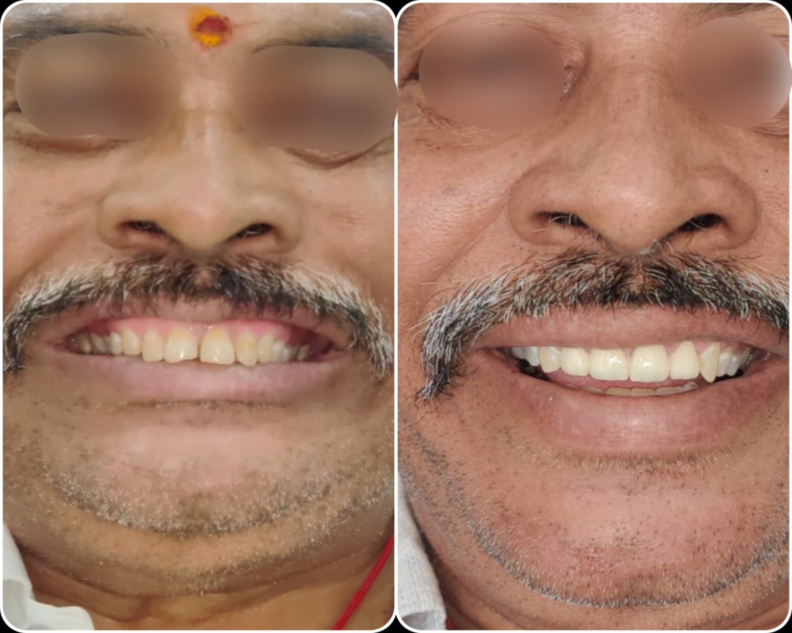 Full-mouth crowns case 6