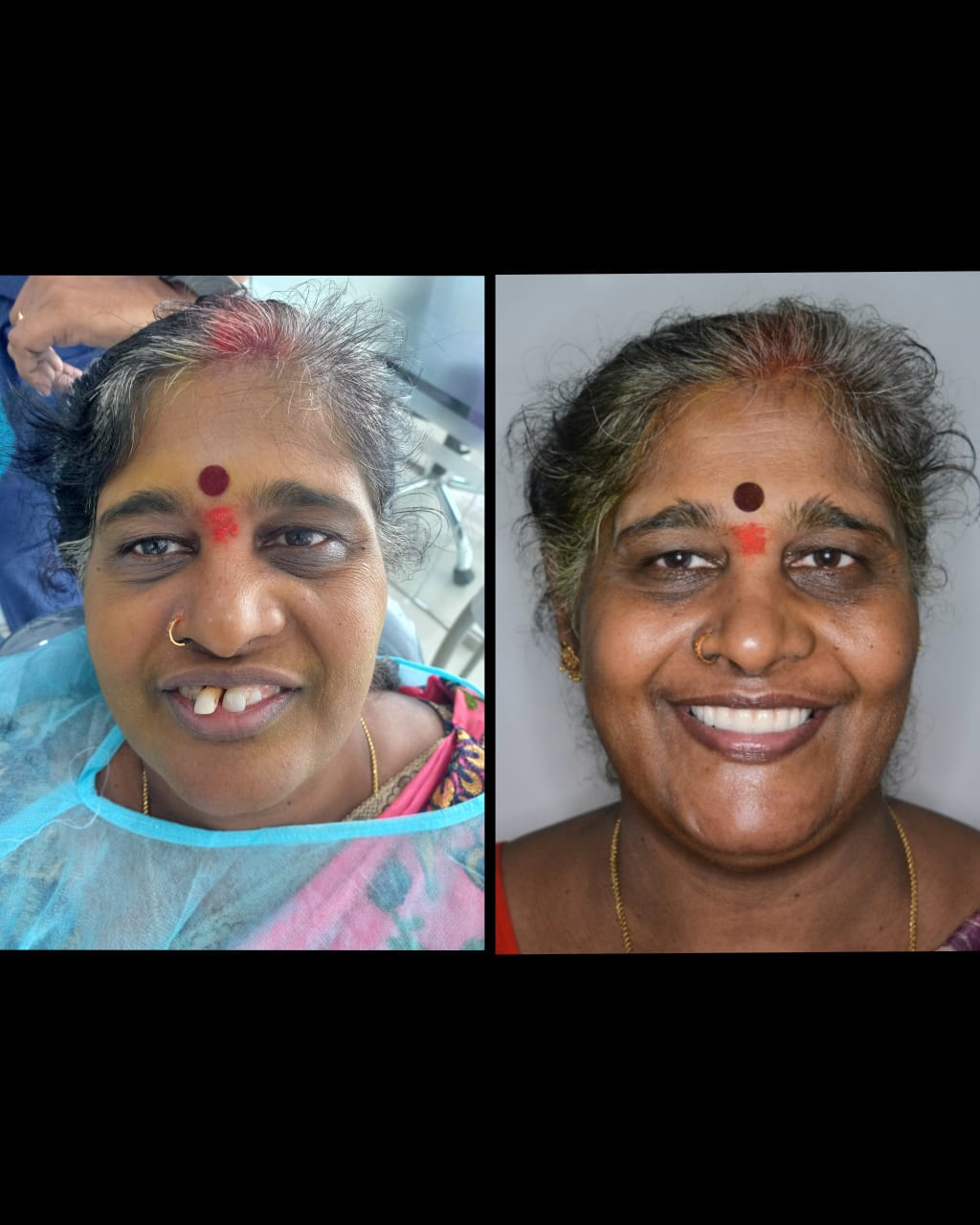 Full-mouth implant smile result