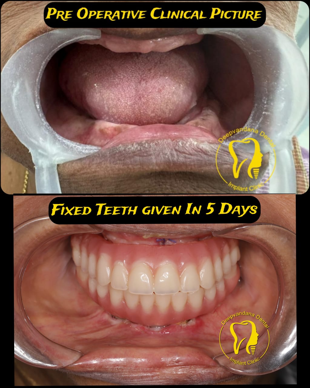 Fixed teeth in 5 days case