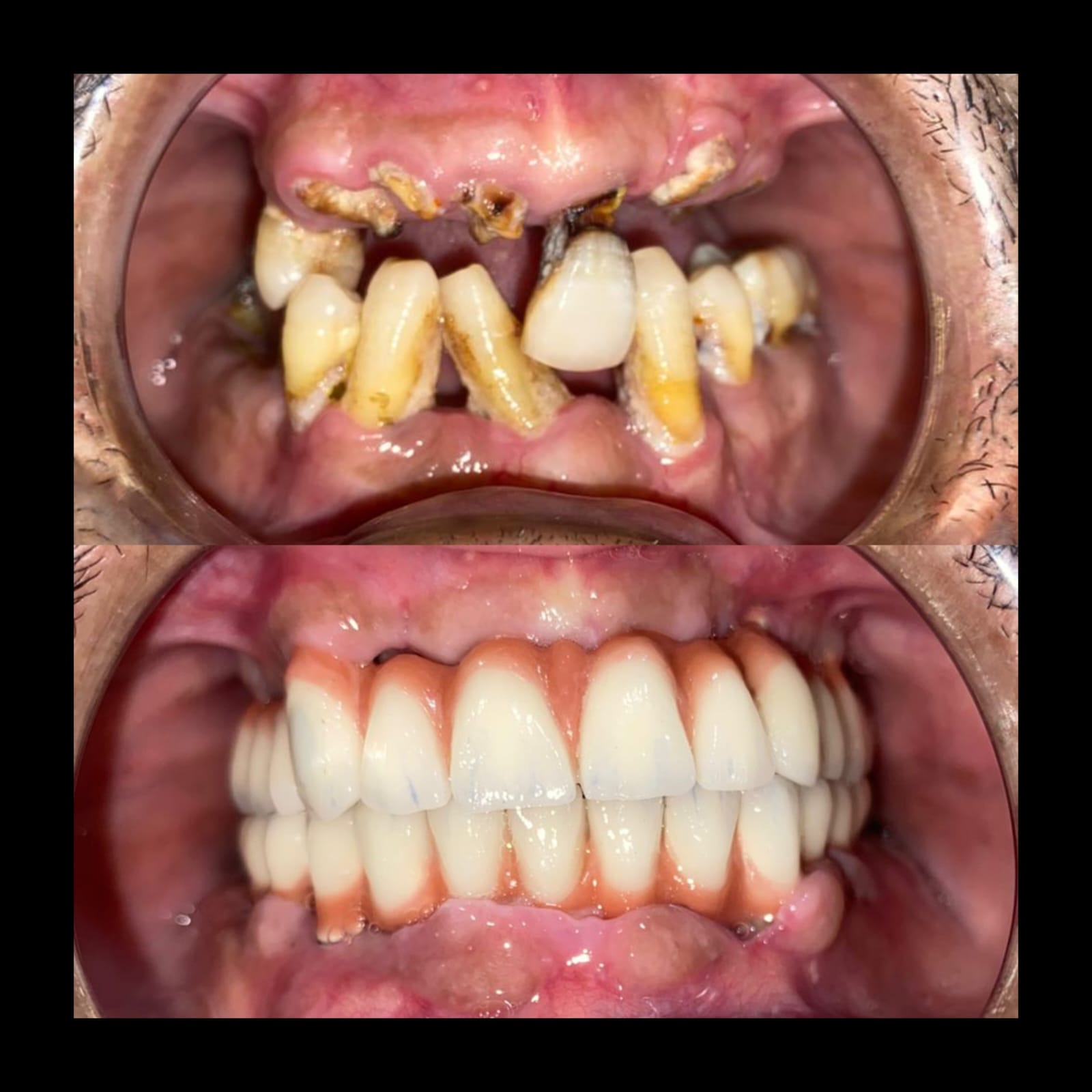 Full-mouth rehabilitation close-up