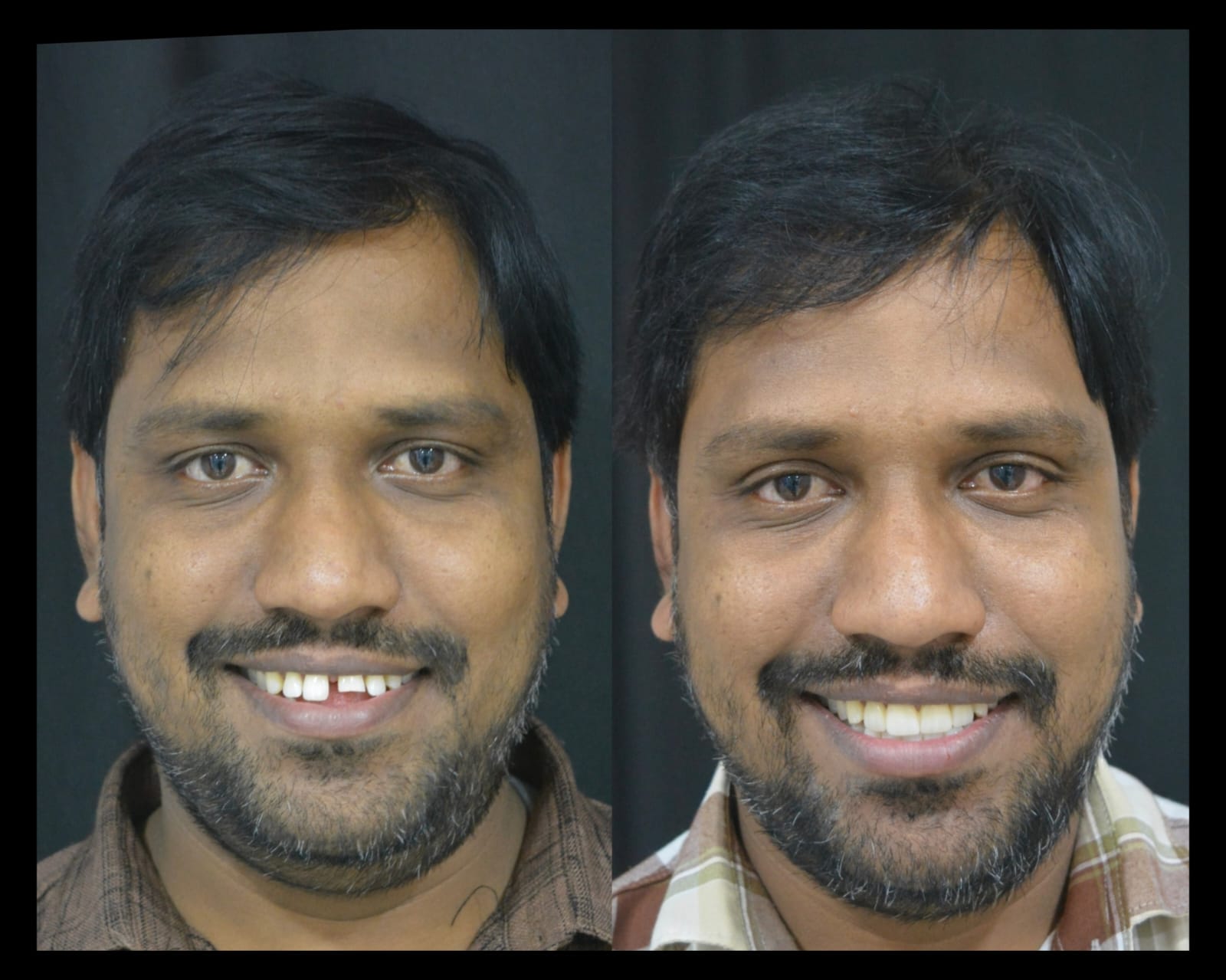 Smile makeover case 1