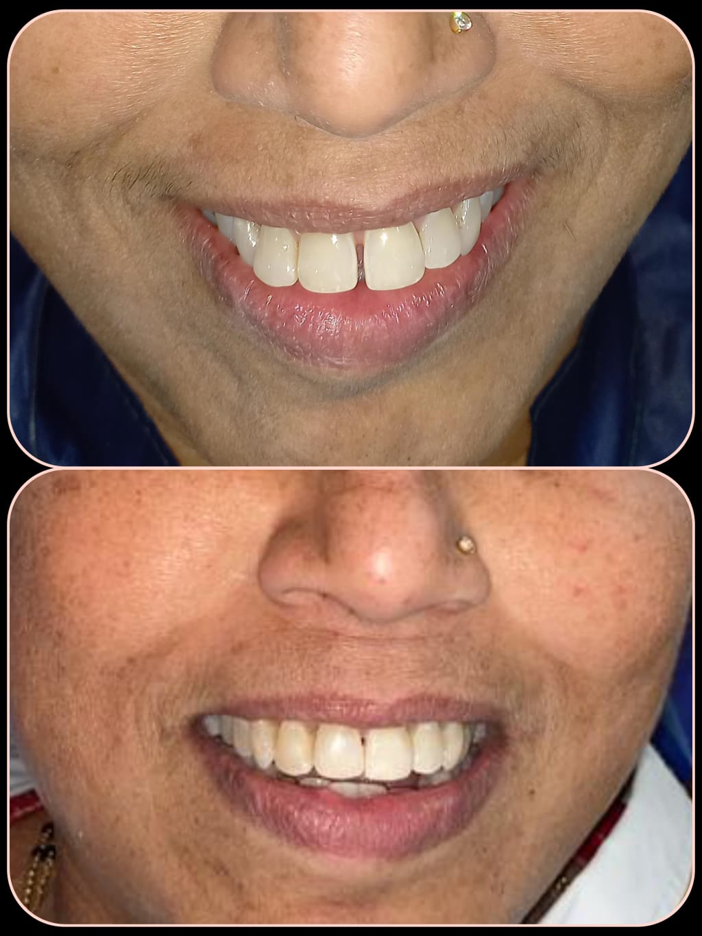 Smile makeover case 2