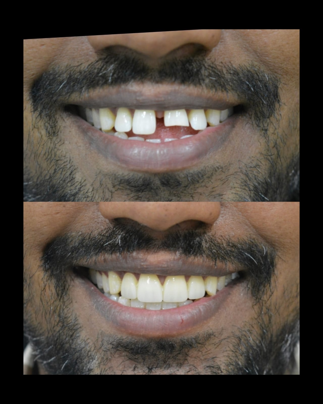 Smile makeover case 3
