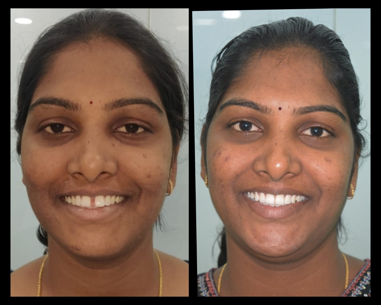 Smile makeover case 11