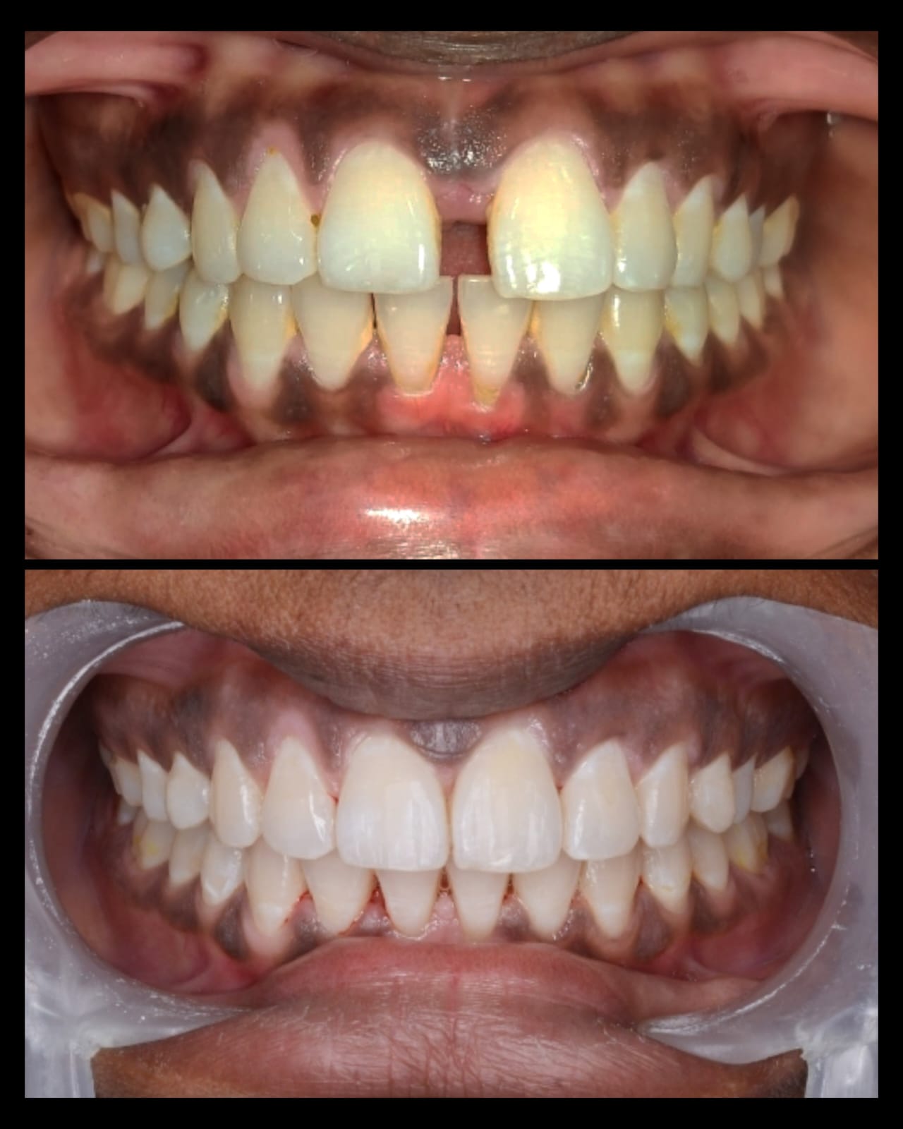 Smile makeover case 12